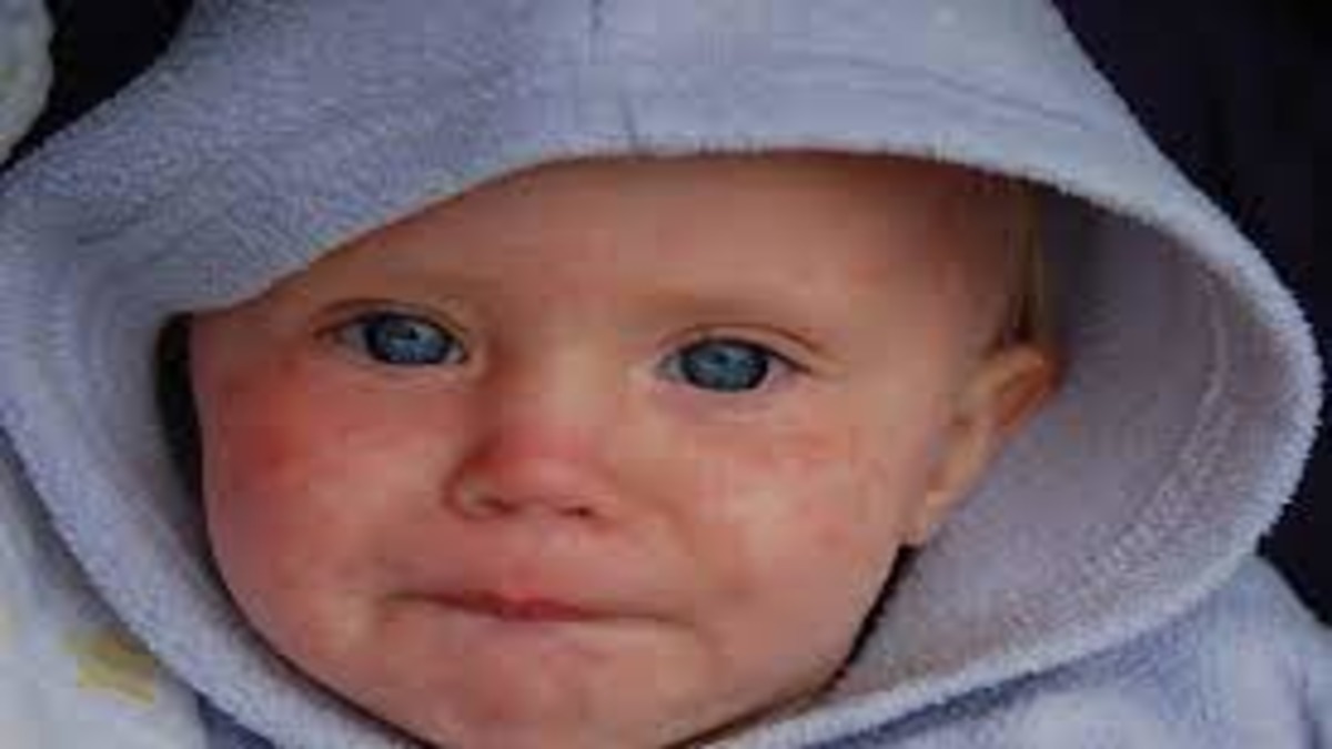 Global Measles Surge: Urgent CDC Alert
