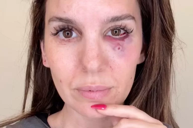 Christy Carlson Romano Injured in Eye Shooting Incident During Husband’s Birthday Celebration